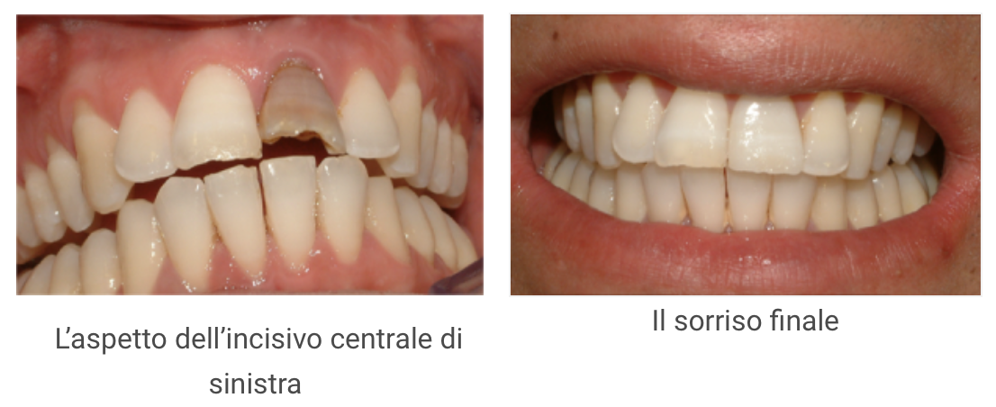 Schermata 2021-01-12 alle 15.57.40 https://www.dentosophy.it/wp-content/uploads/2021/01/Schermata-2021-01-12-alle-15.57.40.png