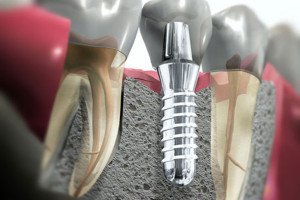 chirurgia-implantare-e1403795627974-300x200 https://www.dentosophy.it/wp-content/uploads/2021/01/chirurgia-implantare-e1403795627974-300x200-1.jpg