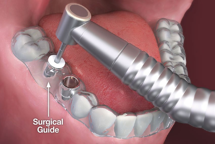 dental-implant-surgical-guide https://www.dentosophy.it/wp-content/uploads/2021/01/dental-implant-surgical-guide.jpg