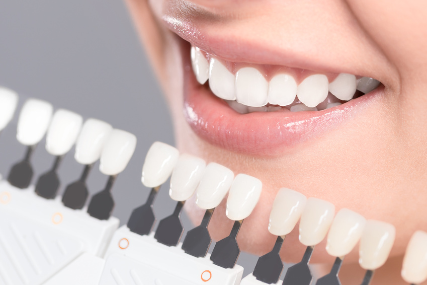 Beautiful smile and white teeth of a young woman. Beautiful smile and white teeth of a young woman. Matching the shades of the implants or the process of teeth whitening.