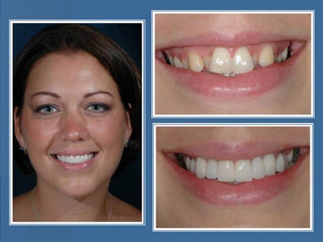 gallery-faccette-dentali-centro-odontoiatrico-grimaldi-01 https://www.dentosophy.it/wp-content/uploads/2021/01/gallery-faccette-dentali-centro-odontoiatrico-grimaldi-01-640x480.jpg
