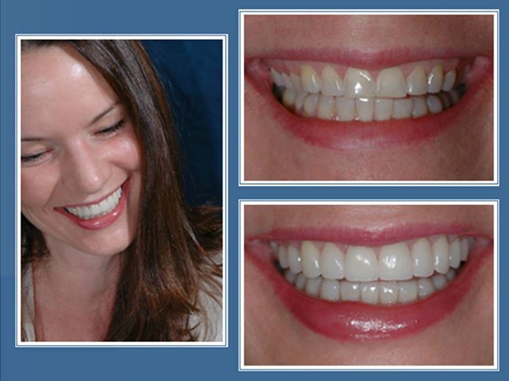 gallery-faccette-dentali-centro-odontoiatrico-grimaldi-02 https://www.dentosophy.it/wp-content/uploads/2021/01/gallery-faccette-dentali-centro-odontoiatrico-grimaldi-02.jpg