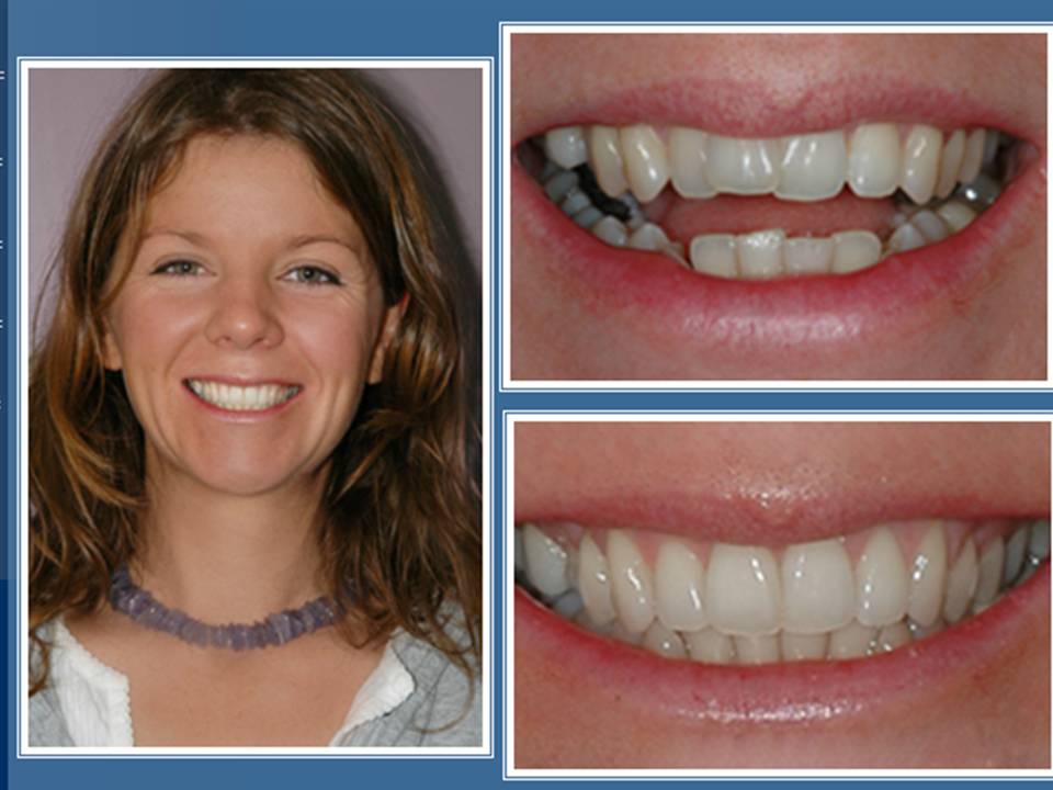 gallery-faccette-dentali-centro-odontoiatrico-grimaldi-03 https://www.dentosophy.it/wp-content/uploads/2021/01/gallery-faccette-dentali-centro-odontoiatrico-grimaldi-03.jpg