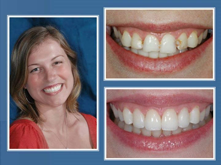 gallery-faccette-dentali-centro-odontoiatrico-grimaldi-04 https://www.dentosophy.it/wp-content/uploads/2021/01/gallery-faccette-dentali-centro-odontoiatrico-grimaldi-04.jpg