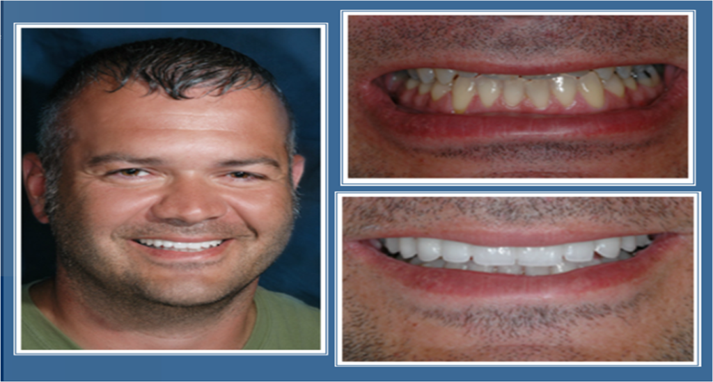 gallery_faccette_dentali_centro_odontoiatrico_grimaldi_02 https://www.dentosophy.it/wp-content/uploads/2021/01/gallery_faccette_dentali_centro_odontoiatrico_grimaldi_02.png