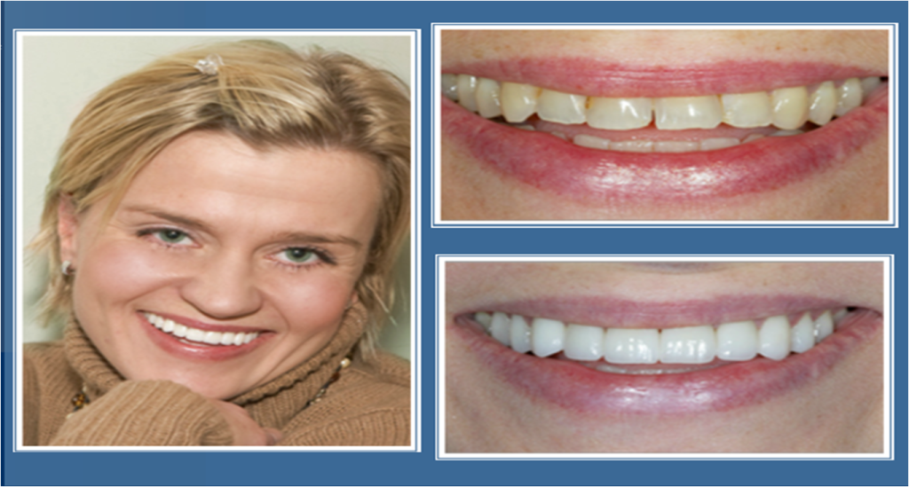 gallery_faccette_dentali_centro_odontoiatrico_grimaldi_03 https://www.dentosophy.it/wp-content/uploads/2021/01/gallery_faccette_dentali_centro_odontoiatrico_grimaldi_03.png