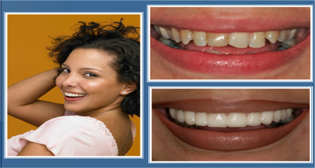 gallery_faccette_dentali_centro_odontoiatrico_grimaldi_04 https://www.dentosophy.it/wp-content/uploads/2021/01/gallery_faccette_dentali_centro_odontoiatrico_grimaldi_04.png