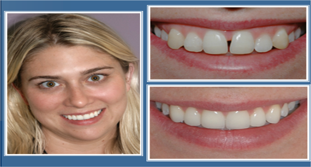 gallery_faccette_dentali_centro_odontoiatrico_grimaldi_05 https://www.dentosophy.it/wp-content/uploads/2021/01/gallery_faccette_dentali_centro_odontoiatrico_grimaldi_05.png