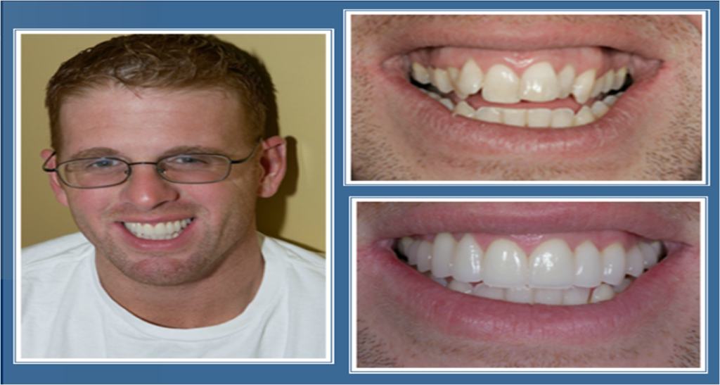 gallery_faccette_dentali_centro_odontoiatrico_grimaldi_06 https://www.dentosophy.it/wp-content/uploads/2021/01/gallery_faccette_dentali_centro_odontoiatrico_grimaldi_06.png