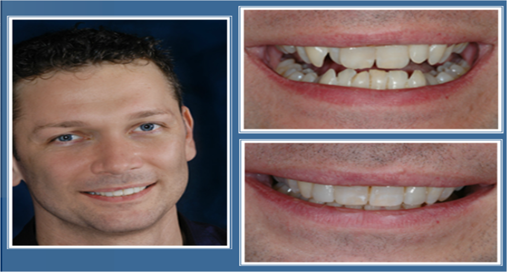 gallery_faccette_dentali_centro_odontoiatrico_grimaldi_07 https://www.dentosophy.it/wp-content/uploads/2021/01/gallery_faccette_dentali_centro_odontoiatrico_grimaldi_07.png