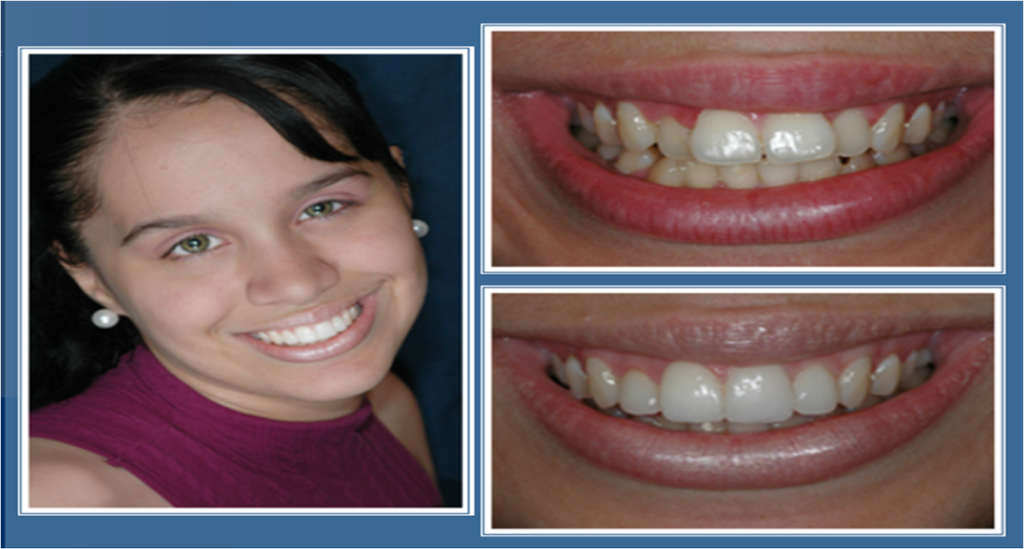 gallery_faccette_dentali_centro_odontoiatrico_grimaldi_12 https://www.dentosophy.it/wp-content/uploads/2021/01/gallery_faccette_dentali_centro_odontoiatrico_grimaldi_12.png